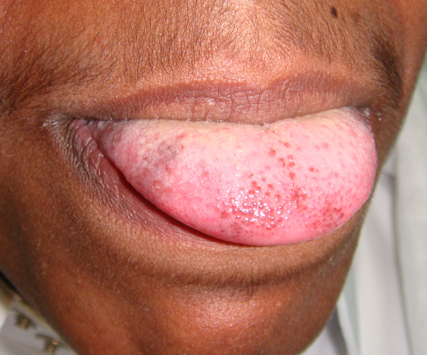 Pictures Of Spots On Tongue 3