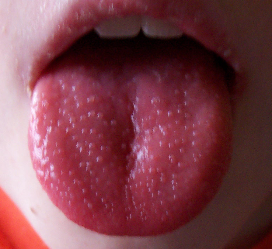 Kawasaki Disease Strawberry Tongue. Review of tongue lesions